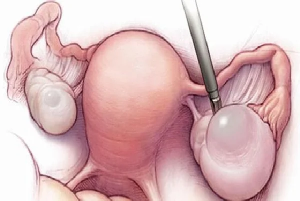 Laparoscopic Ovarian Cystectomy